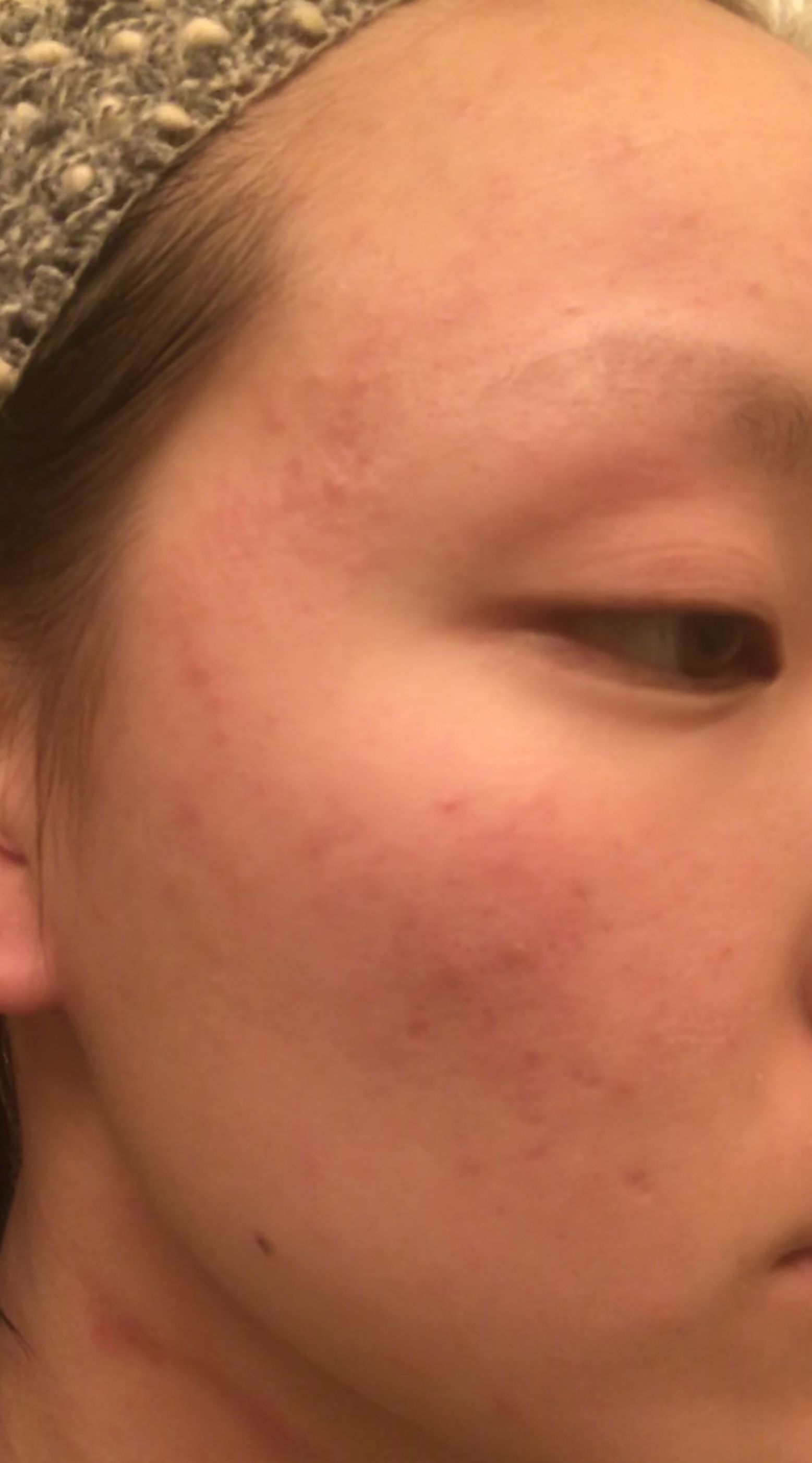 Red Itchy Bumpy Rash On Face General Acne Discussion Acne Org