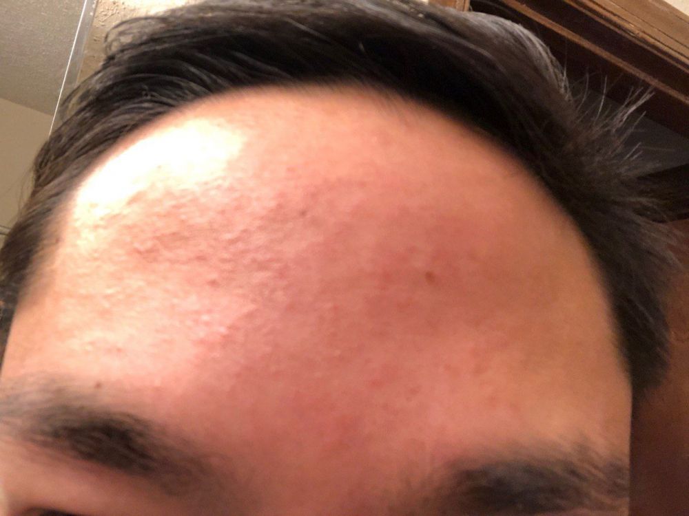 Forehead Bumps Will Not Go Away Affecting Confidence For Work Over