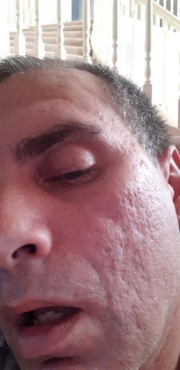 acne.jpg