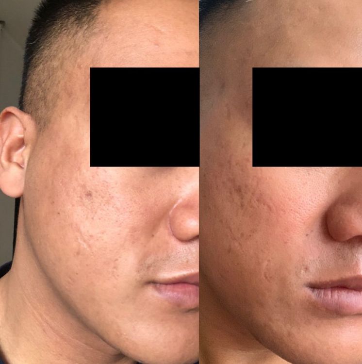before_after_jan_14_02.thumb.jpg.e3d05f7760b3f68f9e66ea5afa8148b2.jpg