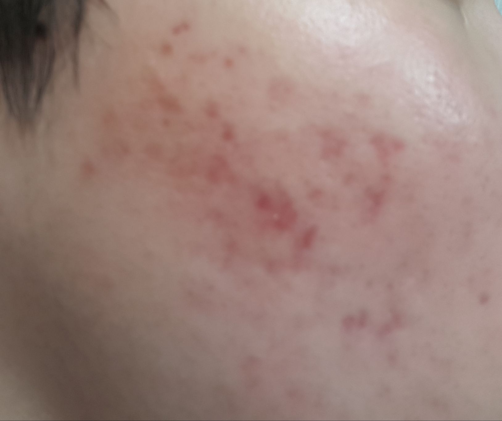 Severe Smooth Red Acne Scars Hyperpigmentation Red dark Marks 