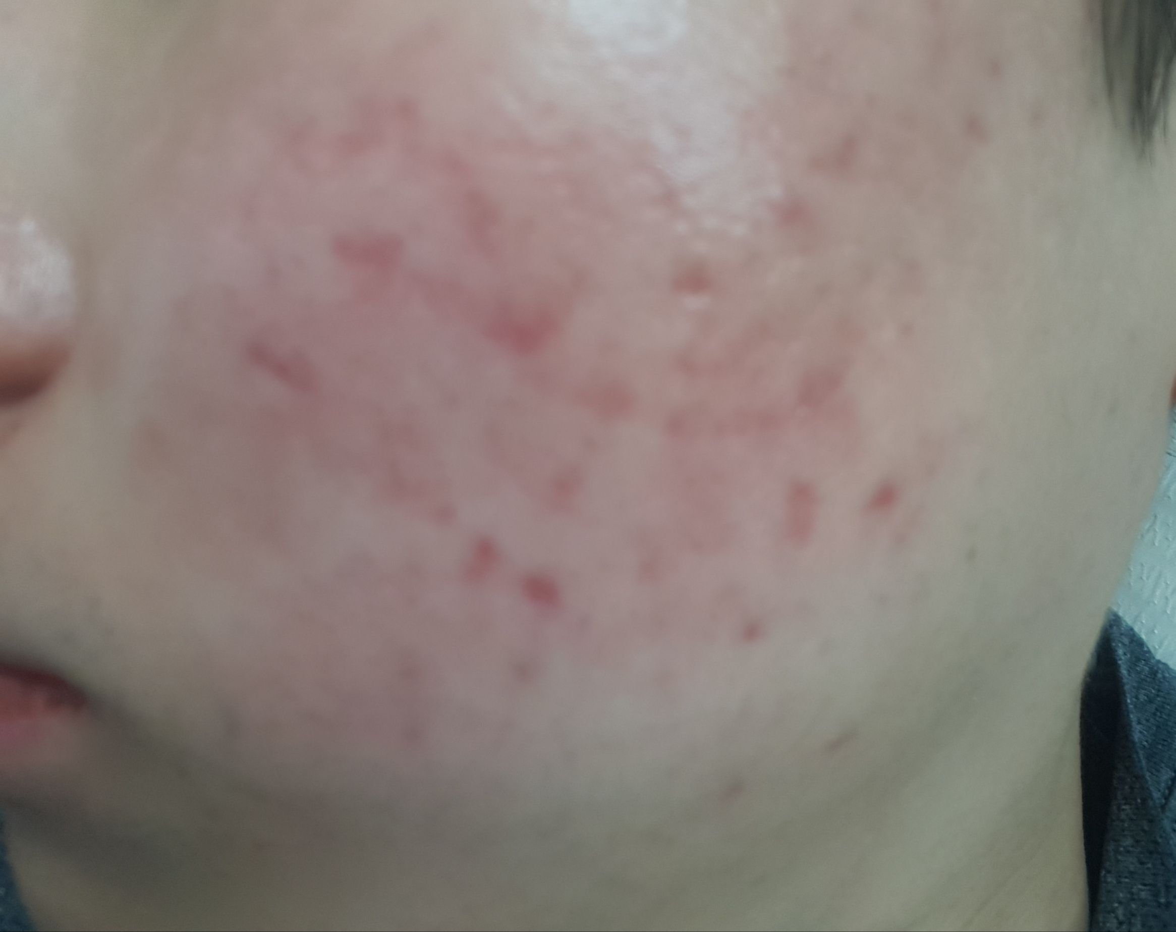 Severe Smooth Red Acne Scars Hyperpigmentation Reddark Marks