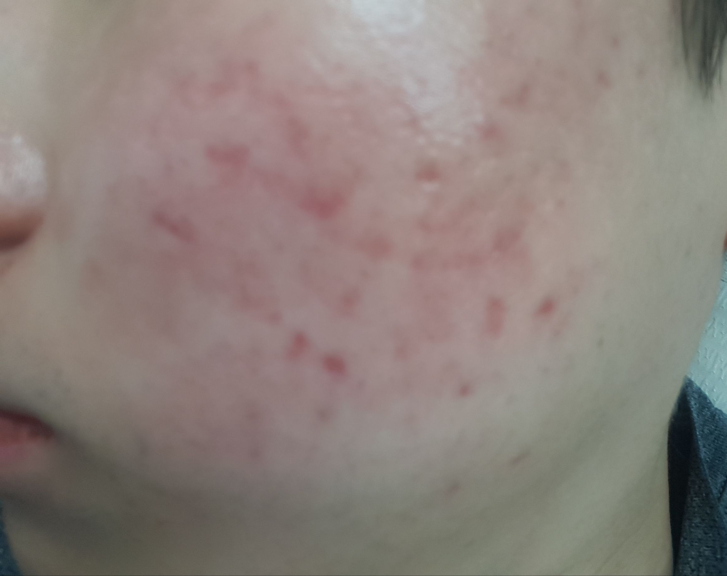 Severe Smooth Red Acne Scars Hyperpigmentation Red dark Marks 