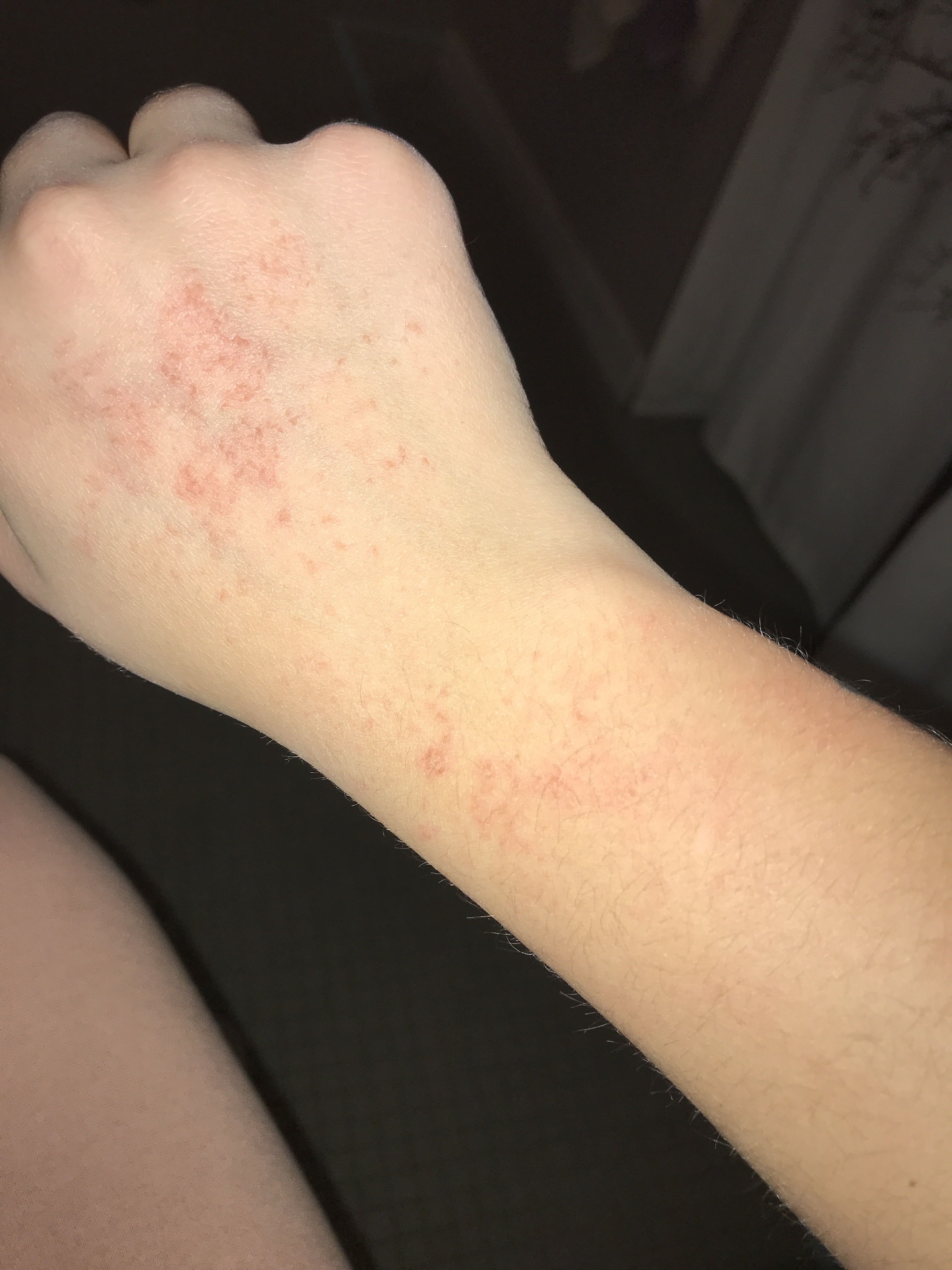 rash on back of hands