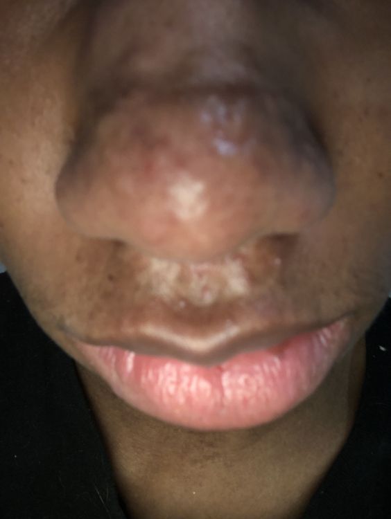 Raised Hypertrophic Nose Acne Scars. Help me plzzz - Hypertrophic
