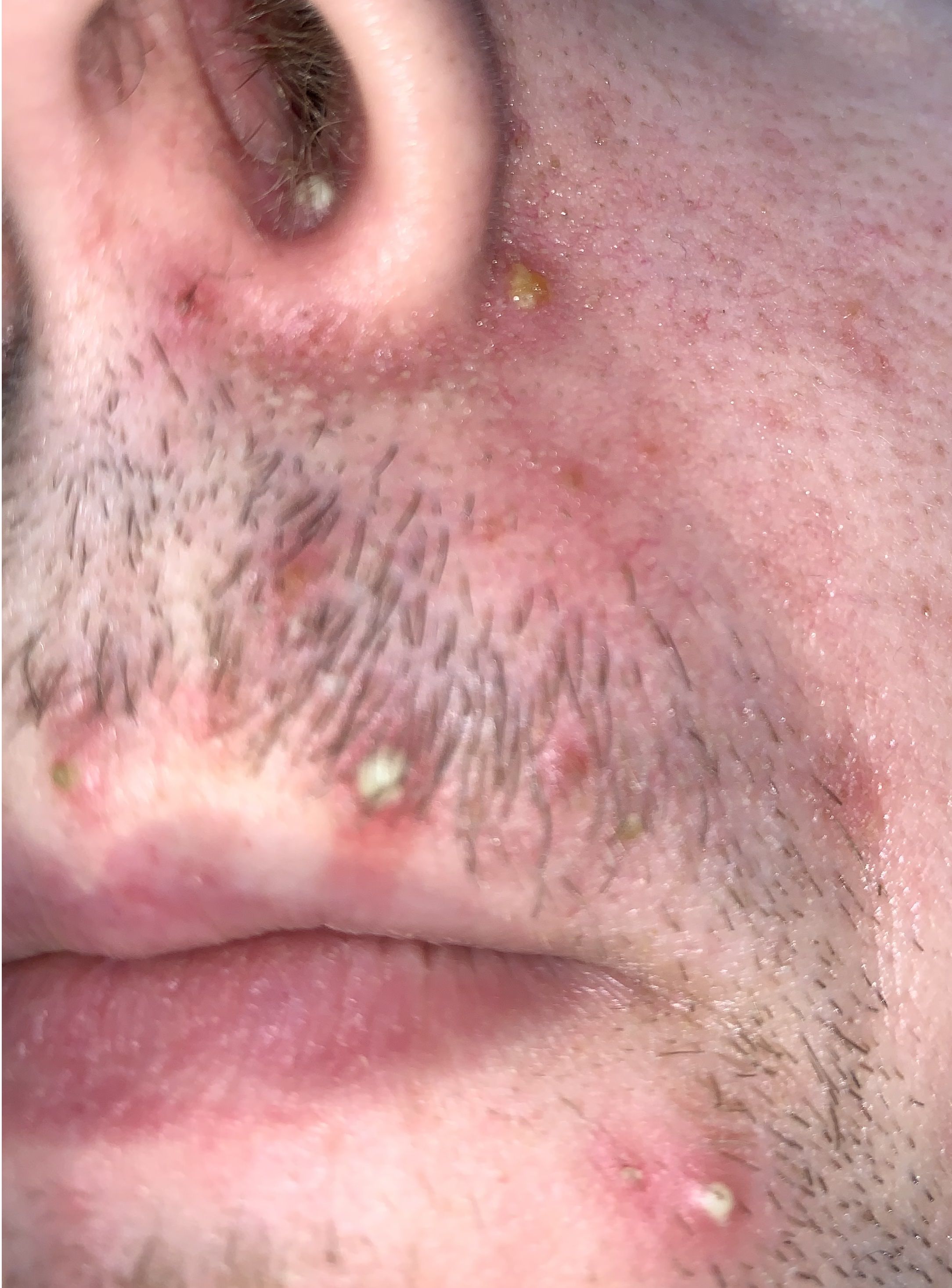 sign problem mouth Pus And Help!  Zits White Page Chin!  Mouth  Around  Help!