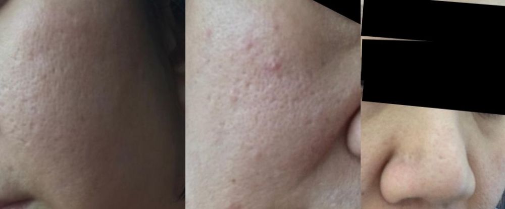 Acne Org.jpg