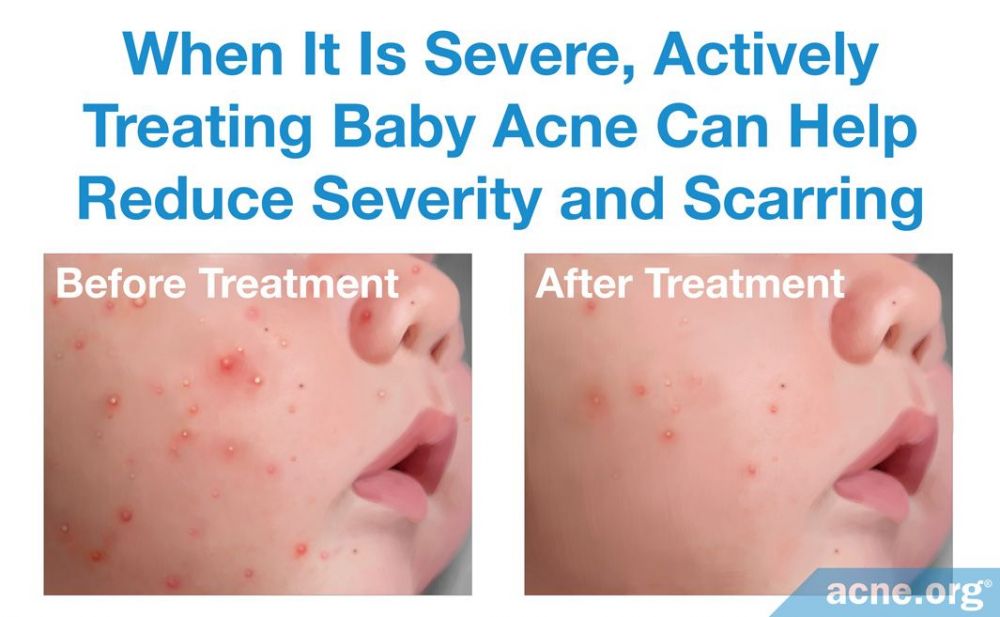 baby-acne-what-is-it-and-what-causes-it-acne