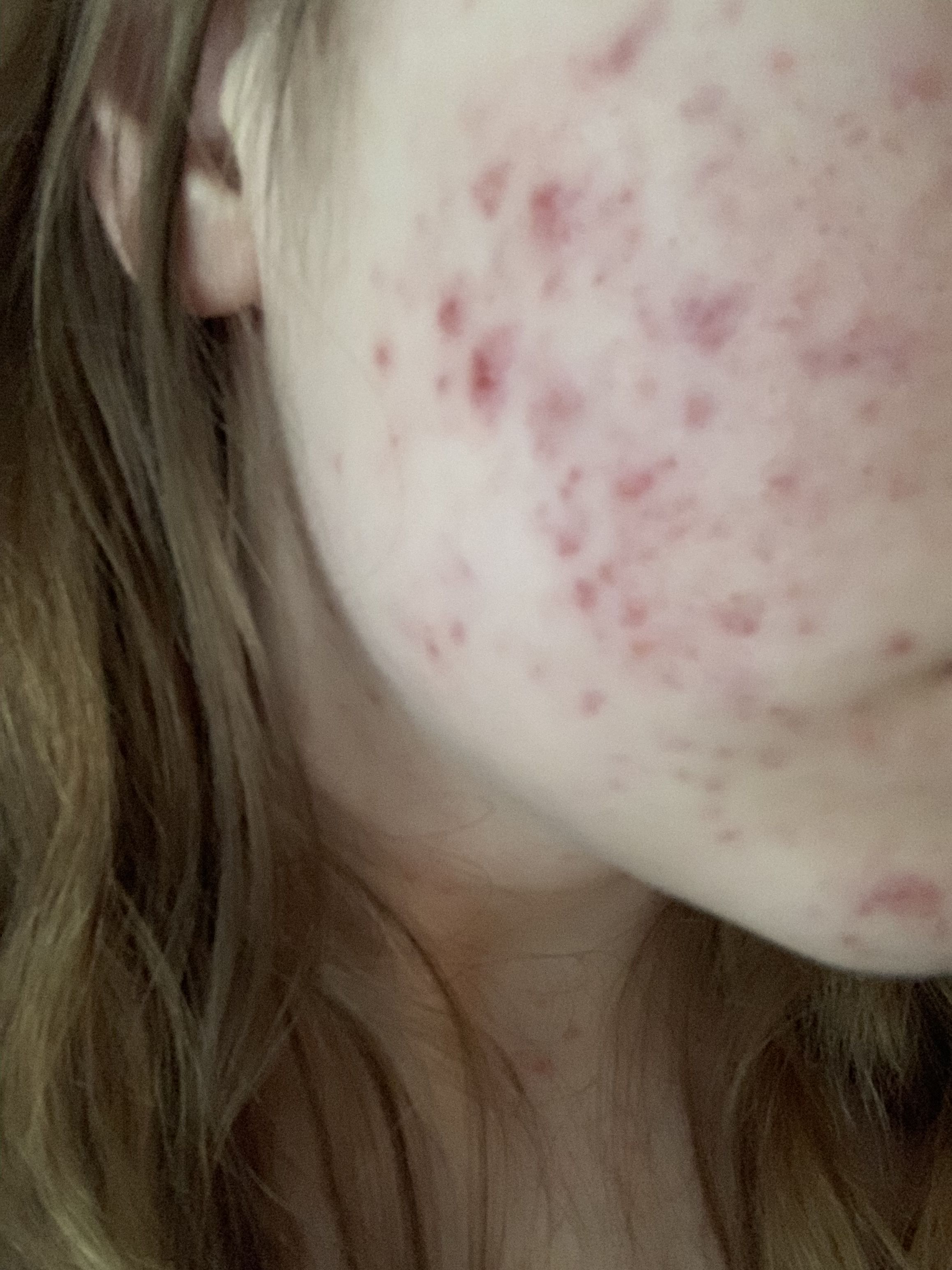 Red marks left over from acne. Any suggestions? - Hyperpigmentation