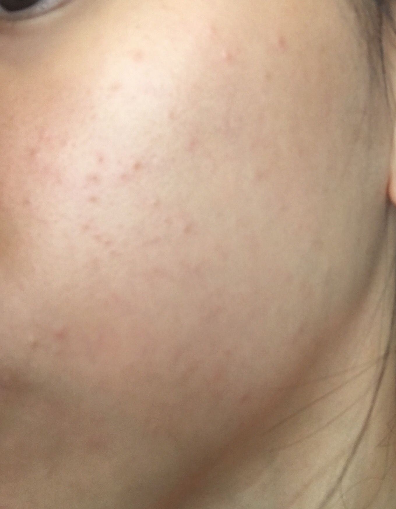 Pimples On My Face That Wonâ€™t Seem To Clear Help General Acne