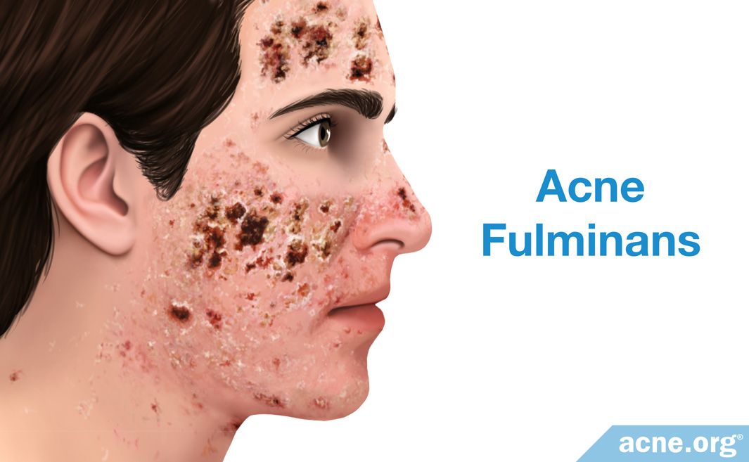 What Medications Can Cause Acne? - Acne.org