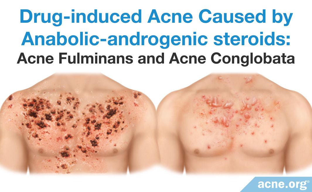 Steroids For Face Acne at Mary Cobbs blog