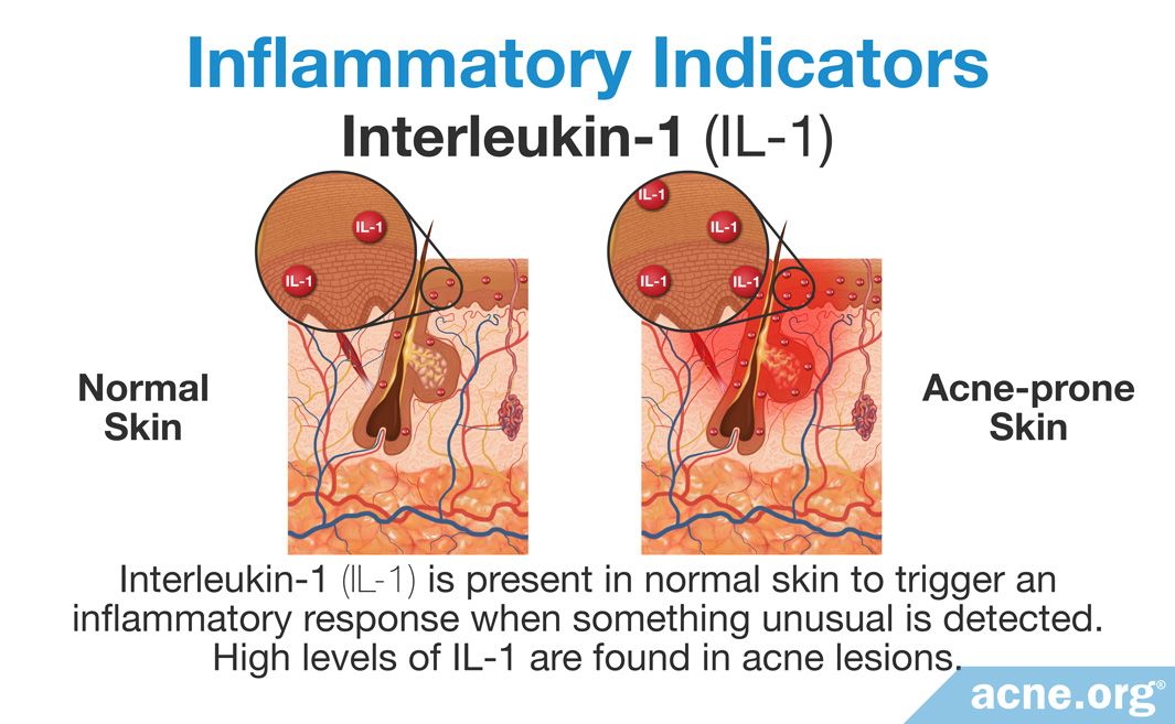 The Role of Inflammation in the Development of Acne - Acne.org