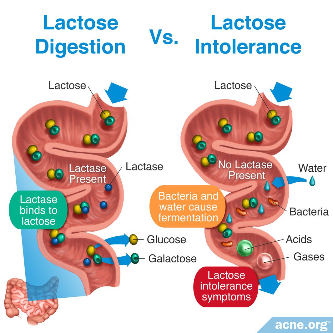 Lactose Intolerance as related to Small Intestine Pictures