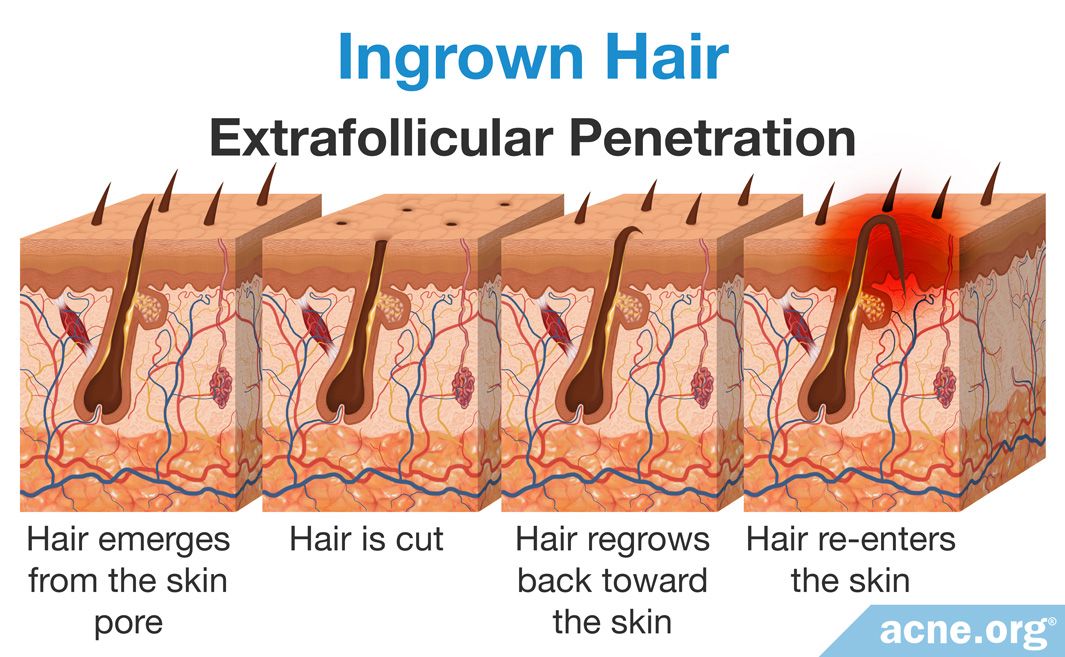 What Are Ingrown Hairs?