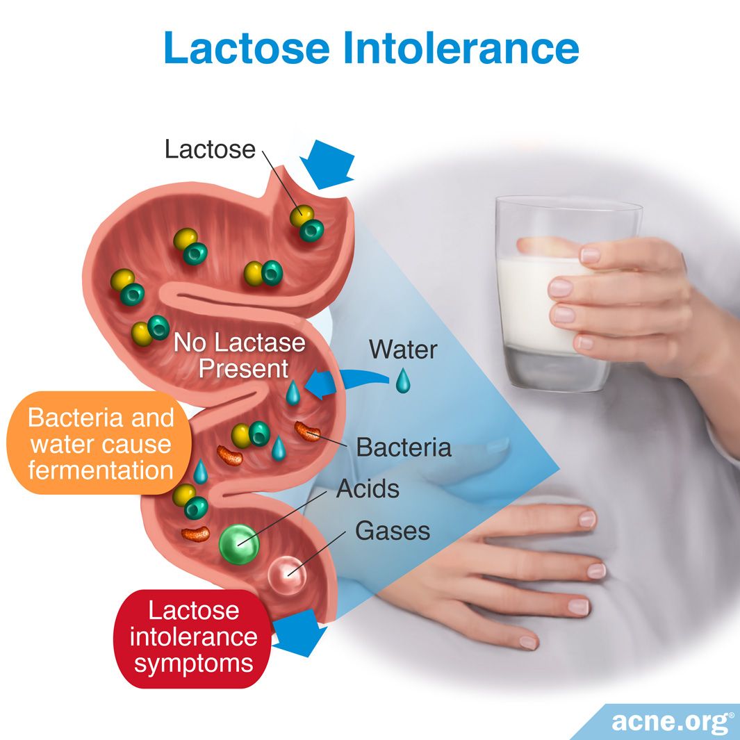 does-lactose-intolerance-relate-to-acne-acne