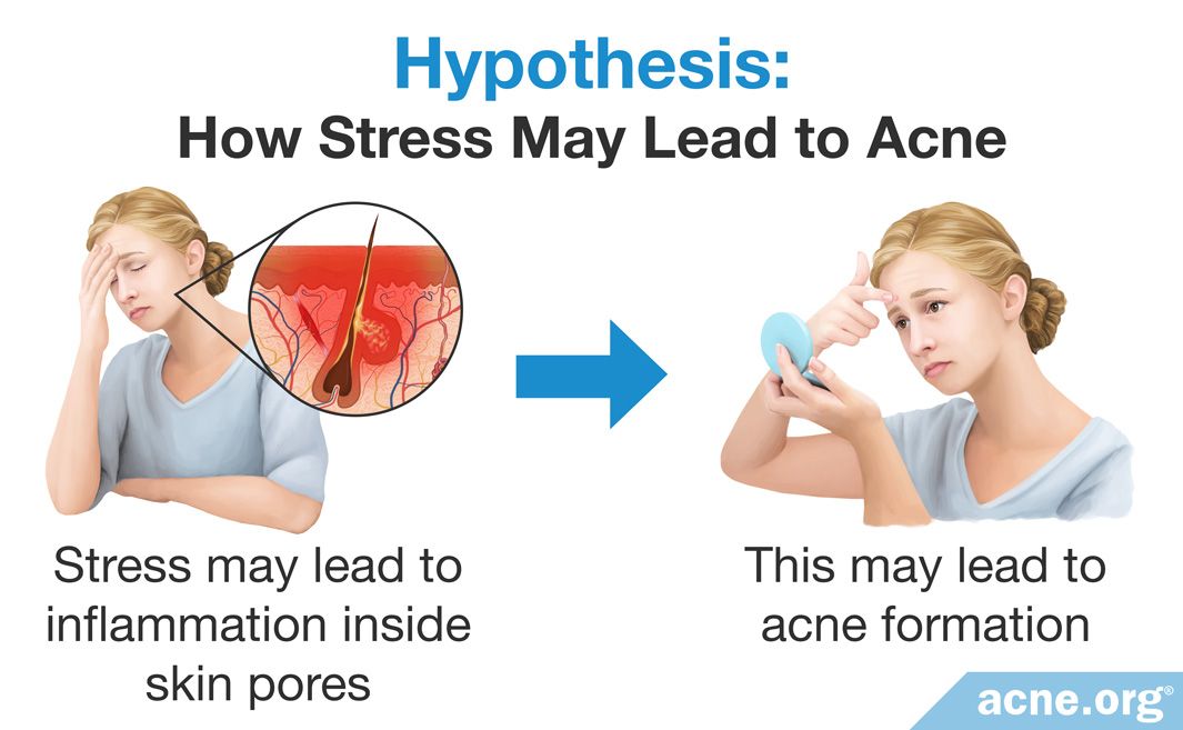 Women Stress And Acne