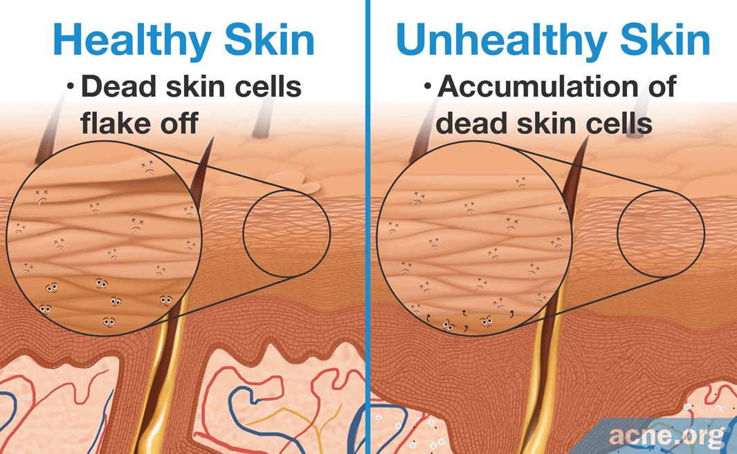 The Role of Hyperkeratinization in Acne - Acne.org