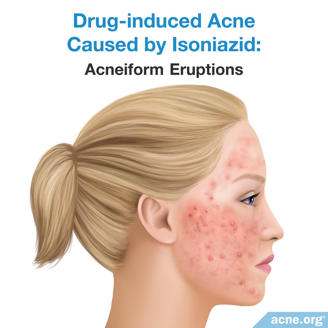 What Medications Can Cause Acne? - Acne.org