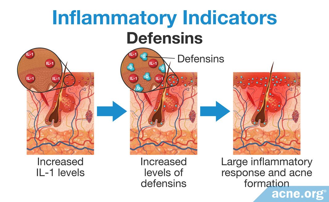 The Role Of Inflammation In The Development Of Acne 