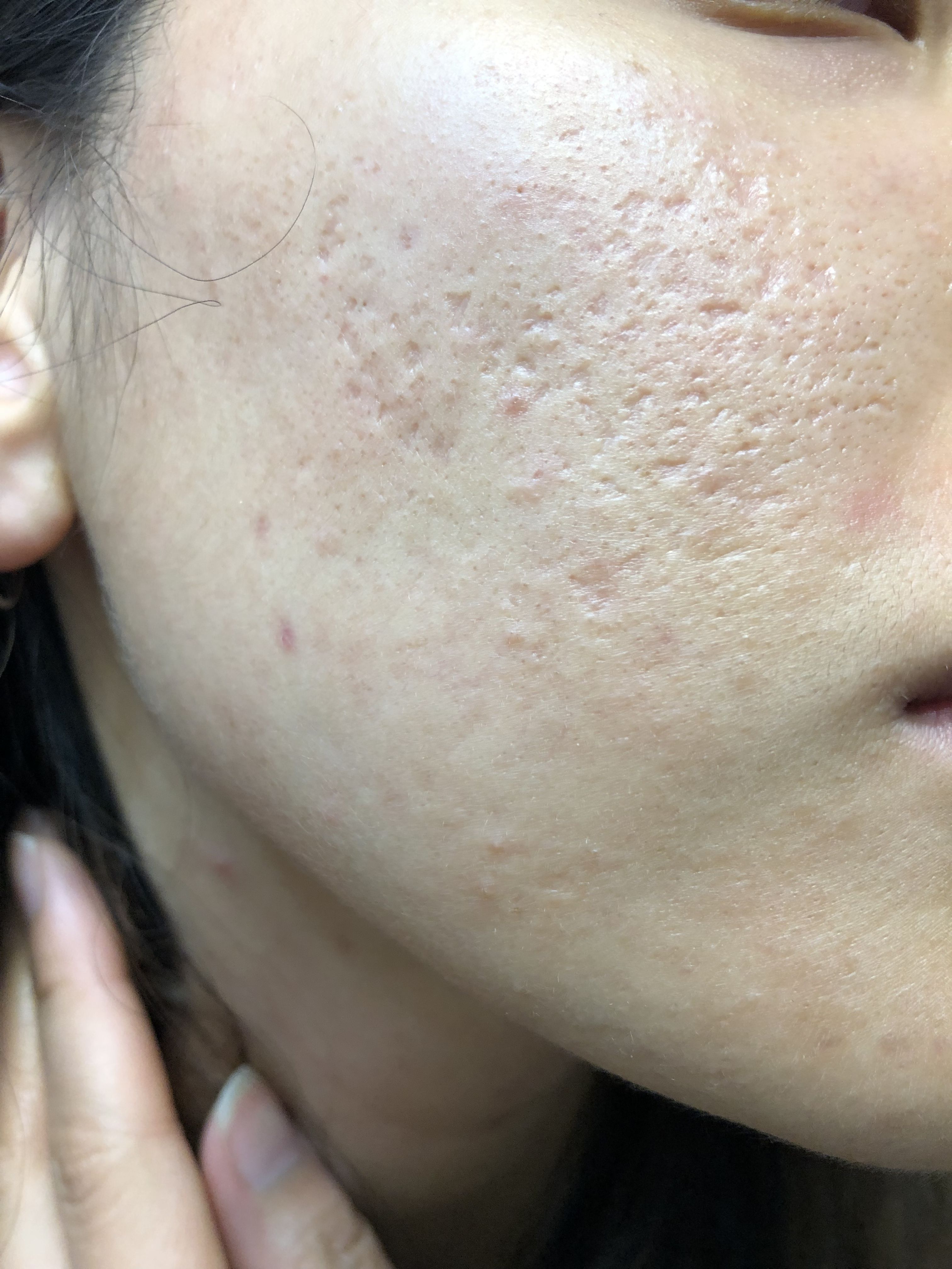 What Should I Do? Acne Scars - Scar Treatments - Acne.org