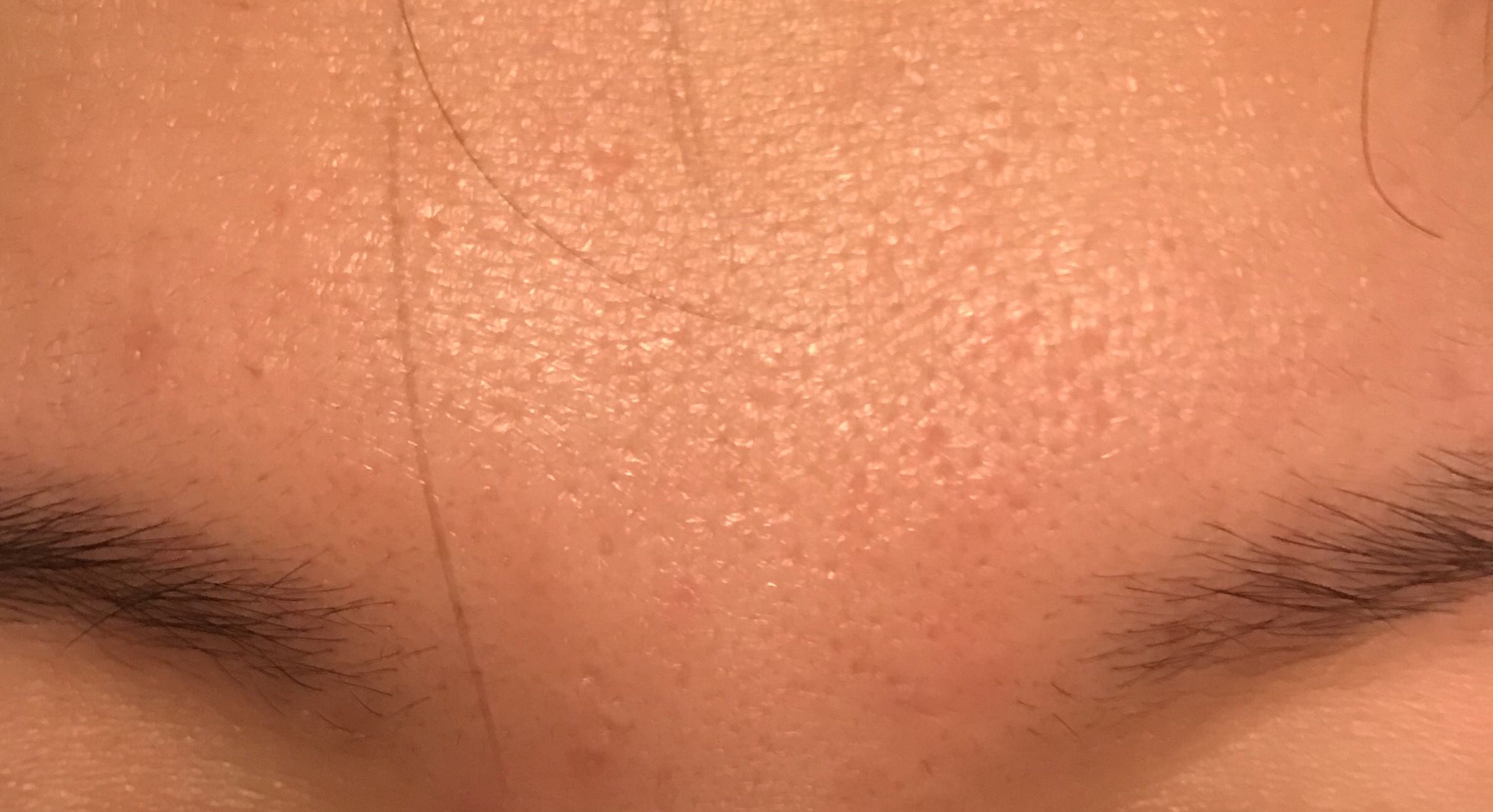 HELP! What kind of acne scars do I have? - Scar treatments - Acne.org