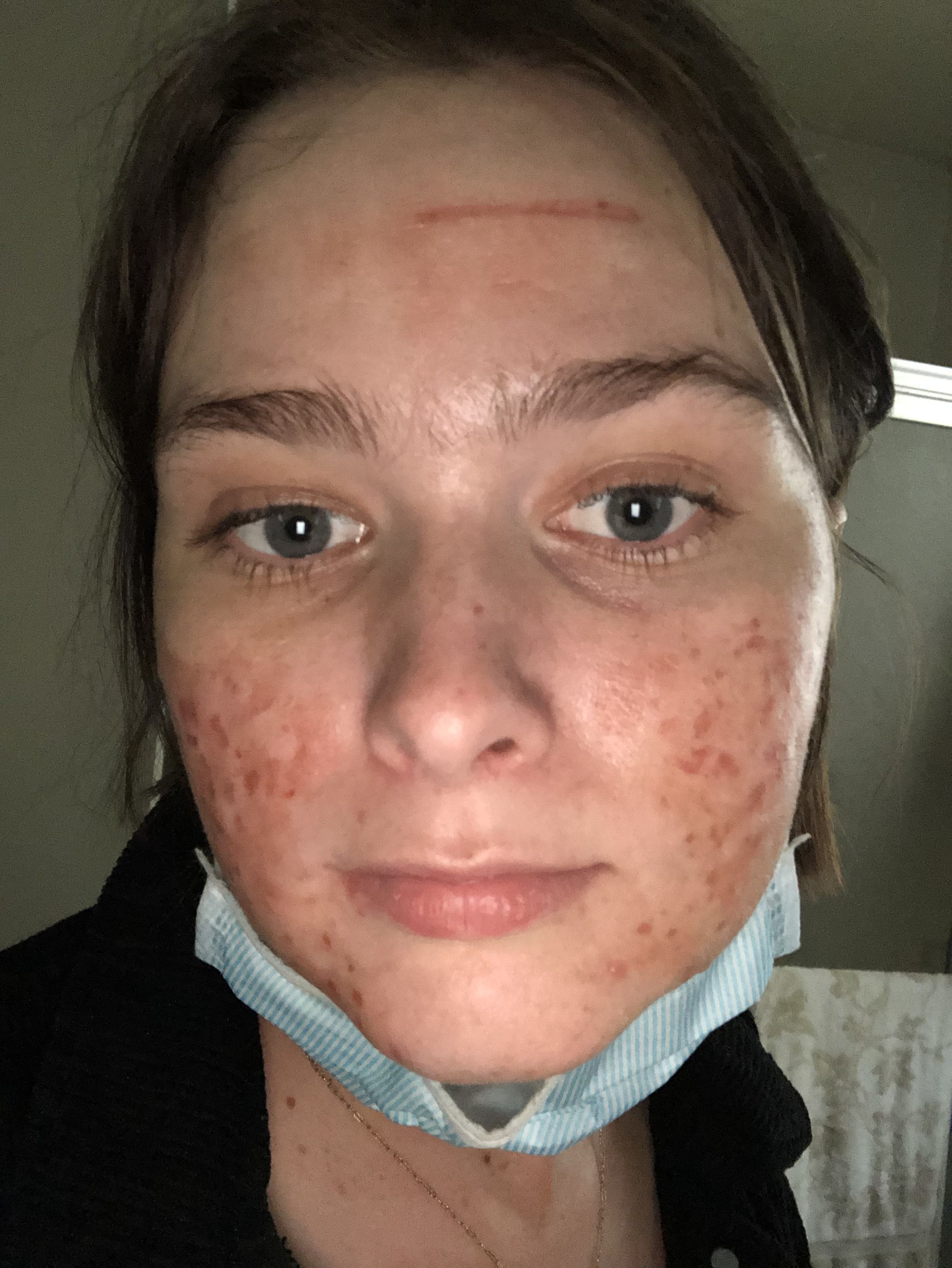 CO2 laser in treating acne scars – ultrapulse & Subcision of Acne Scars W/ Dr  Lim Dr Rullan and Other Drs – Success Story in Progress – Page 3 – Scar  treatments –  Forum