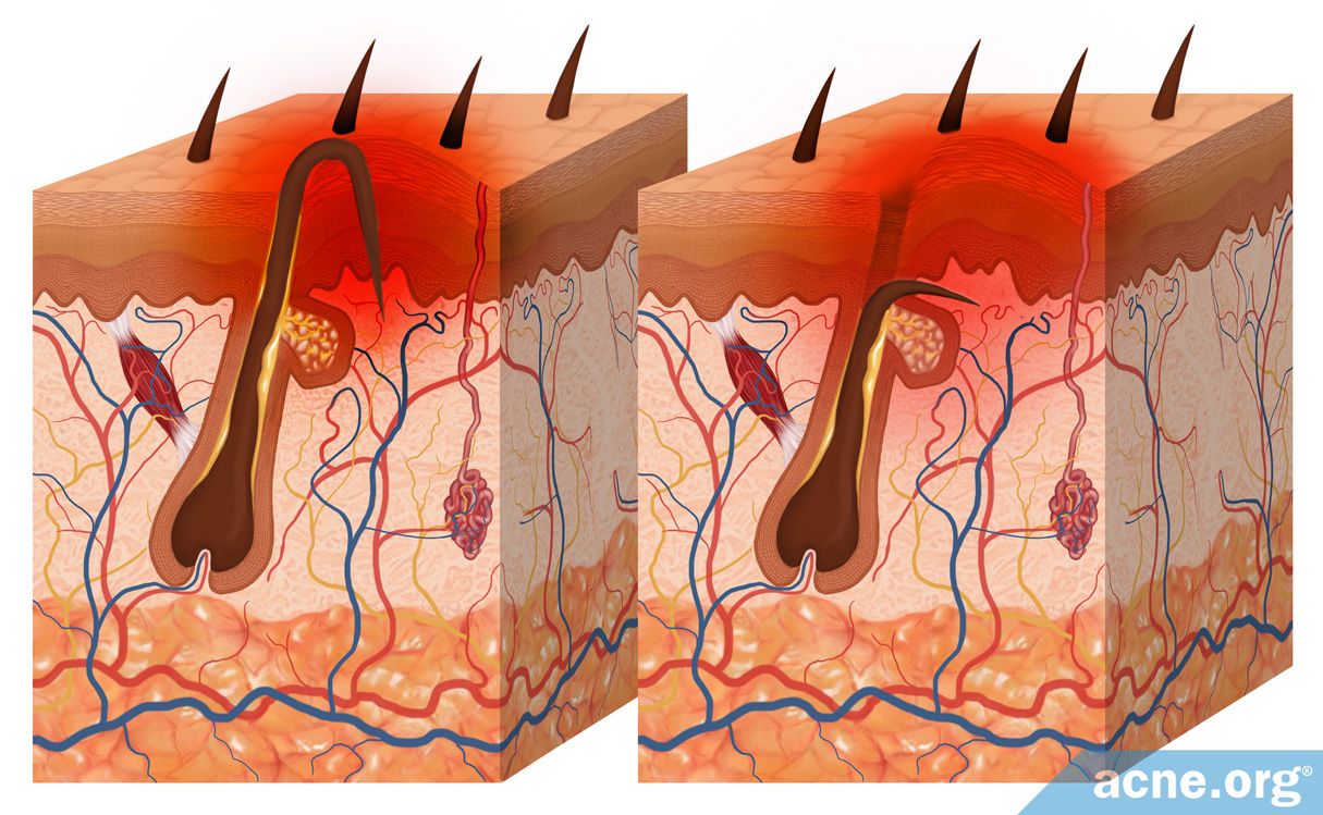 Ingrown Hair Diagram