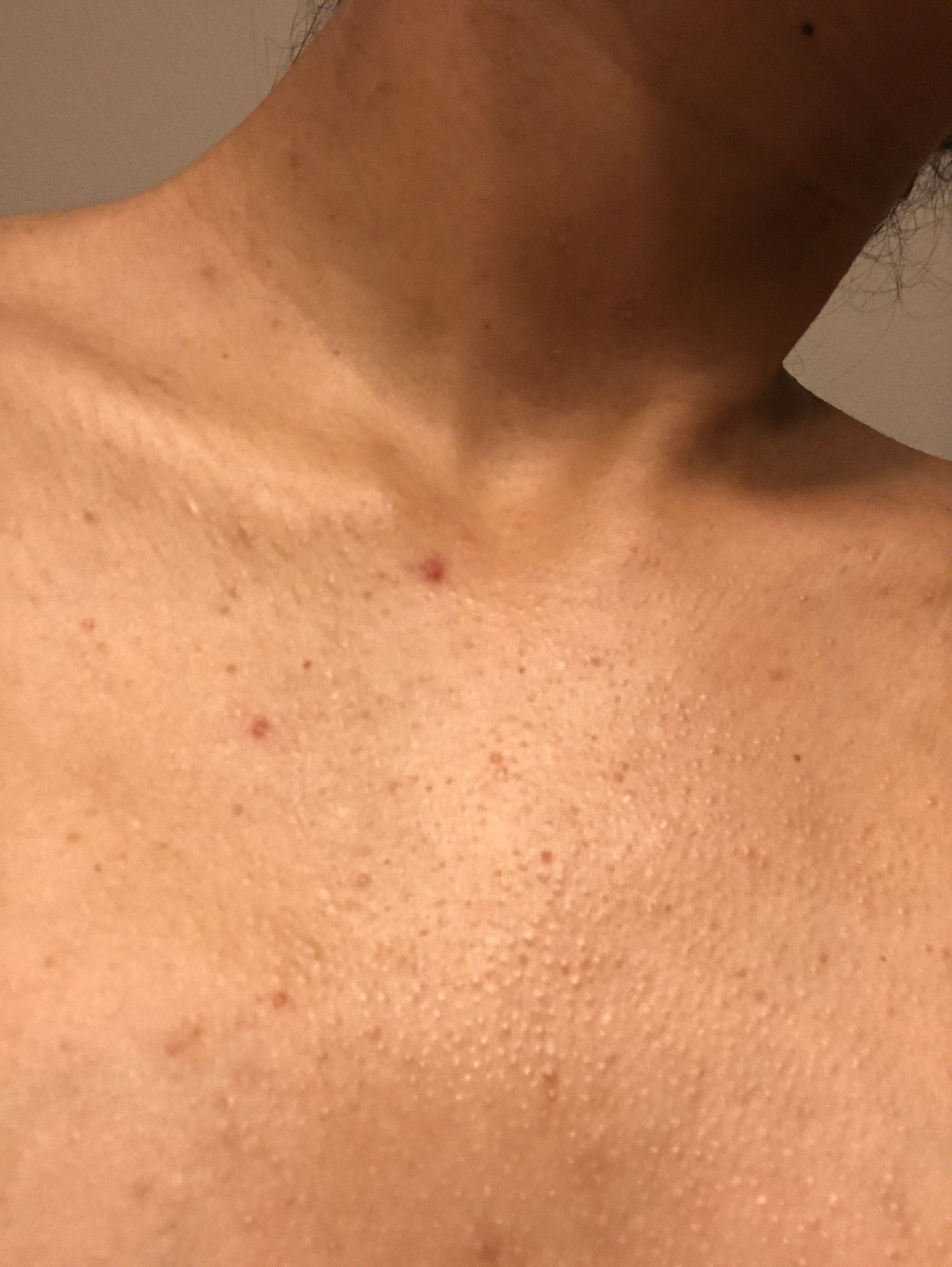 Pesky acne on shoulders hALP – Back/Body/Neck acne –  Forum