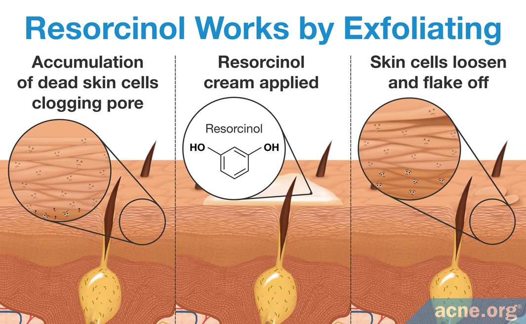 Resorcinol Everything You Need To Know 2221