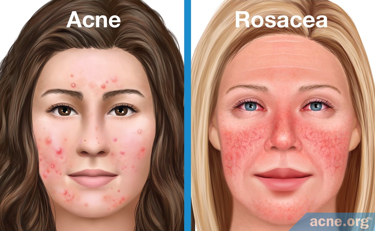 Comedonal Acne Vs Inflammatory Acne