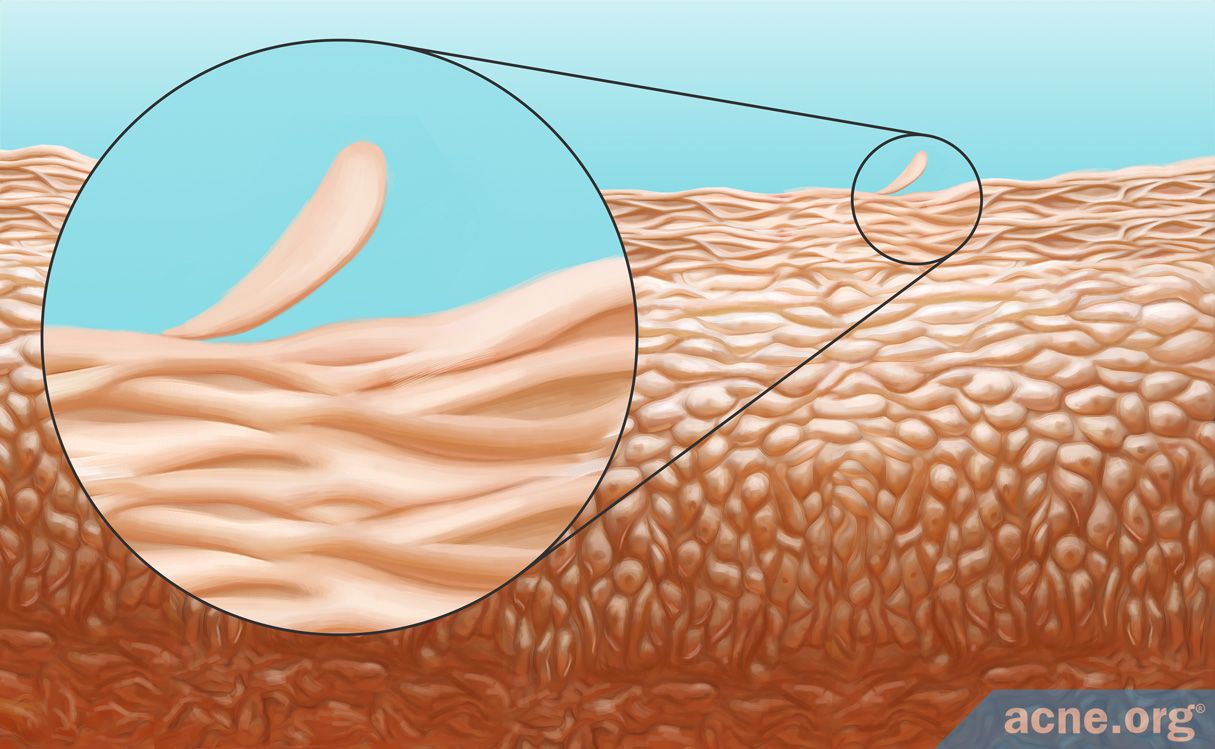 How Exfoliation Helps with Acne - Acne.org