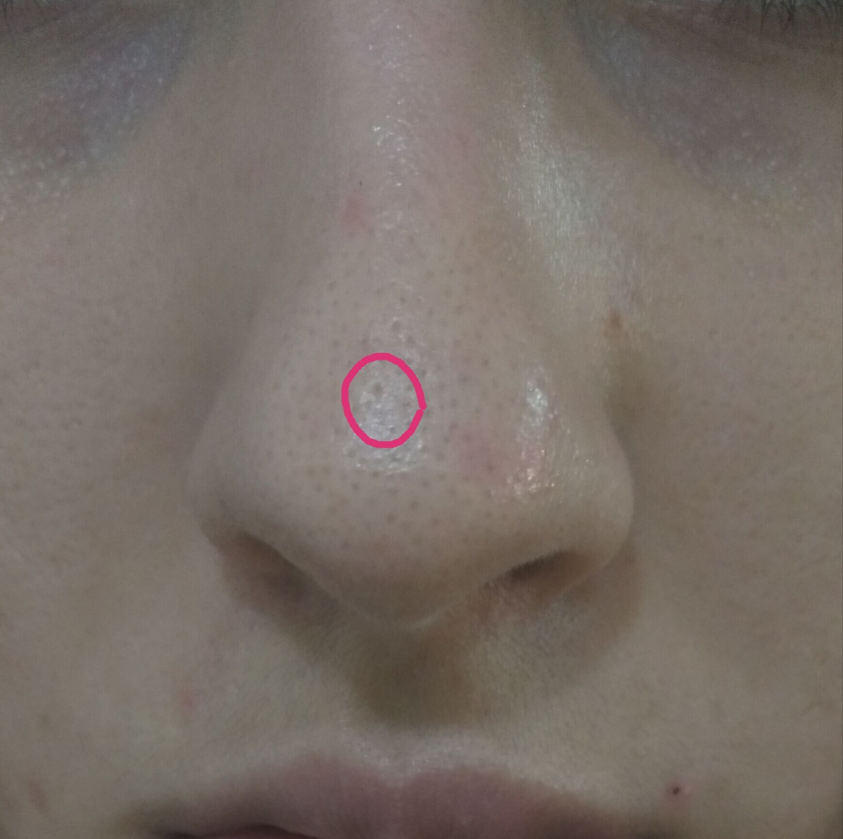 Help Me Indented Scarscarred Pore On The Nose Scar Treatments