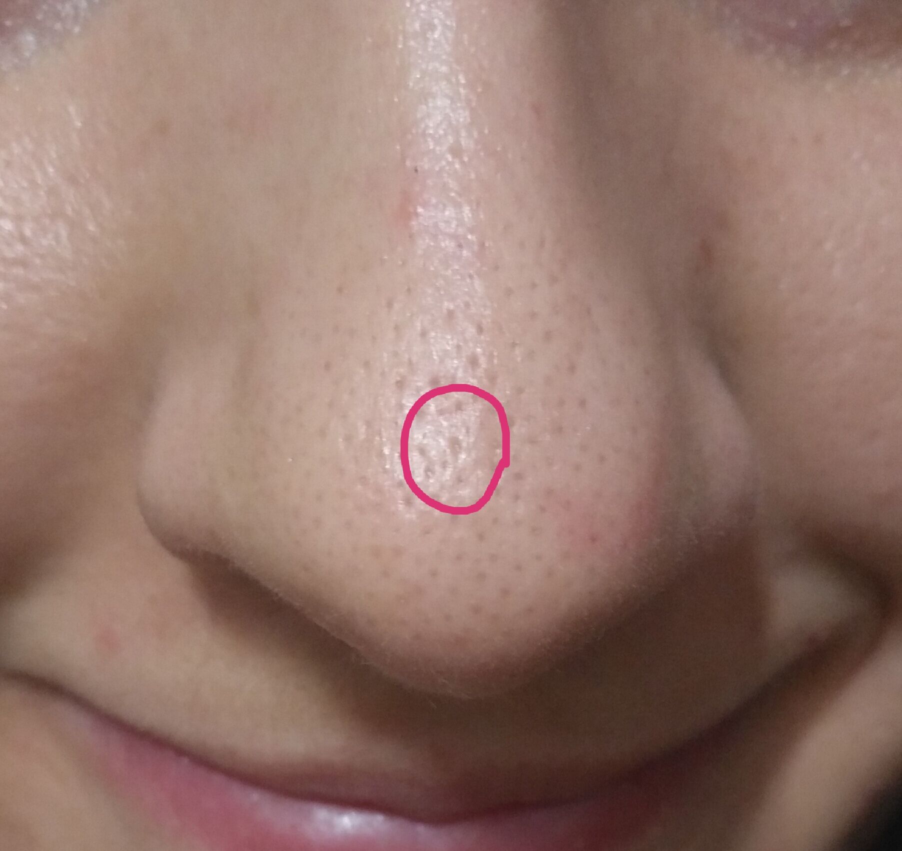 Help Me Indented Scarscarred Pore On The Nose Scar Treatments
