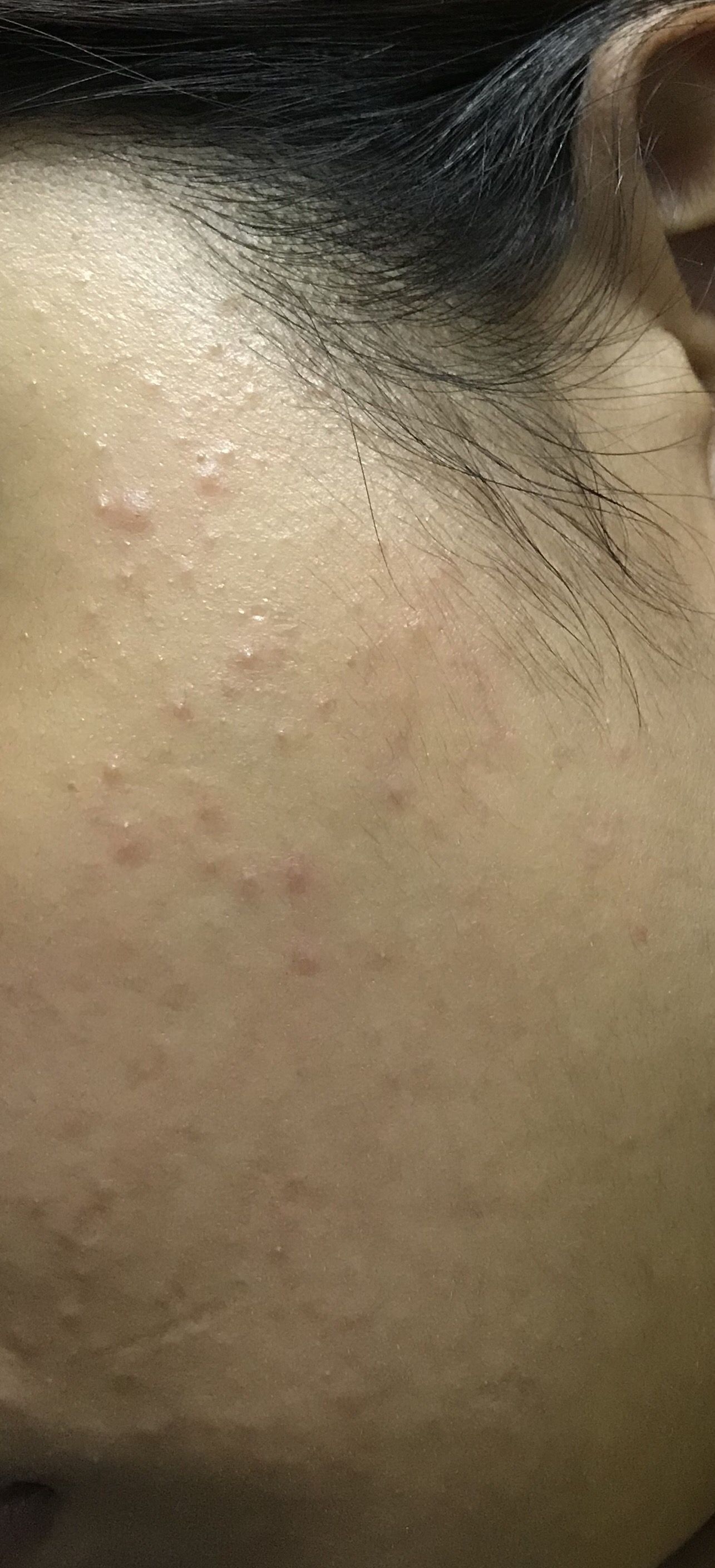 Sudden Tiny Bumps On Face General Acne Discussion Forum