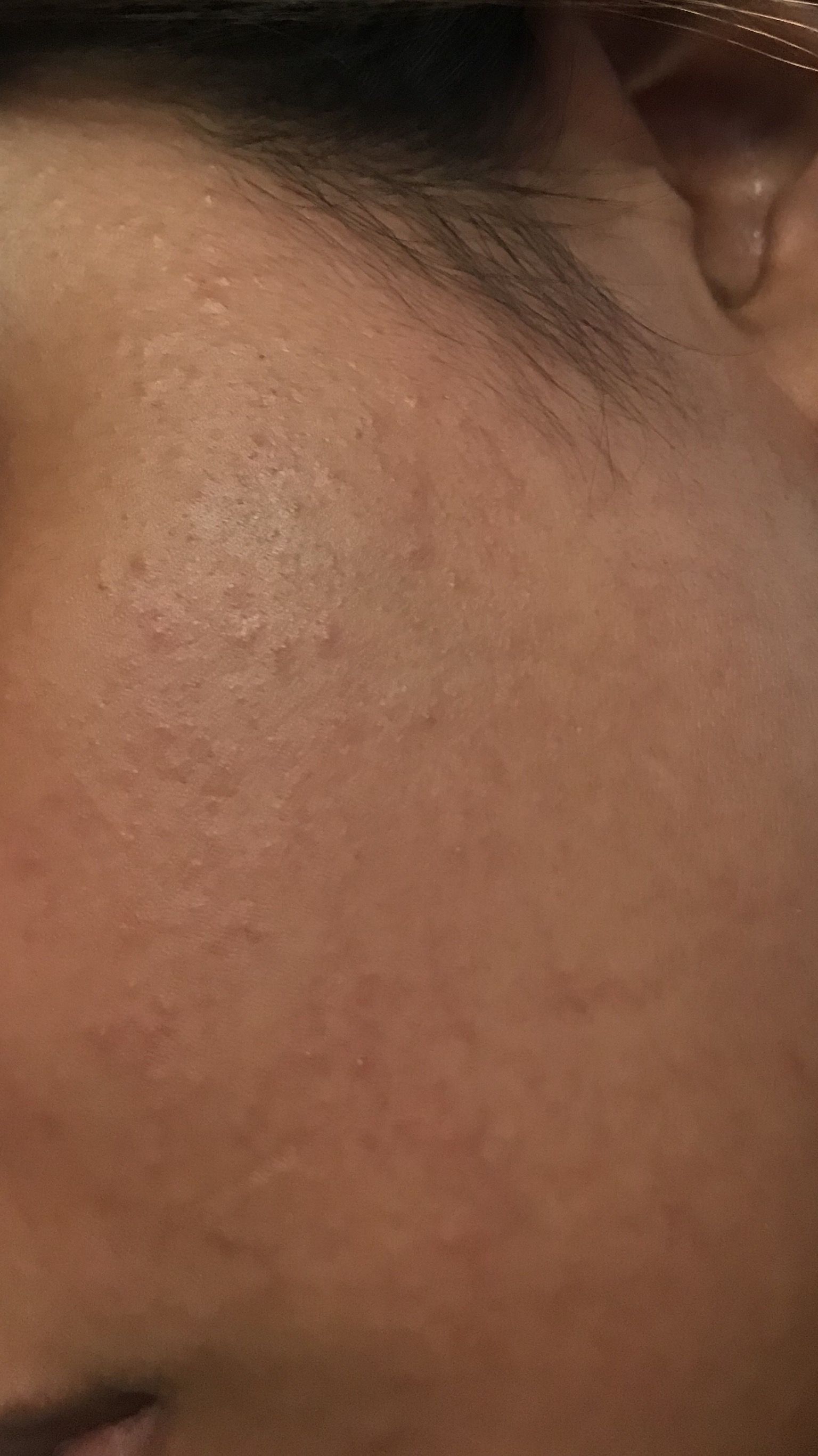 White Bumps On Face 8 Year Old