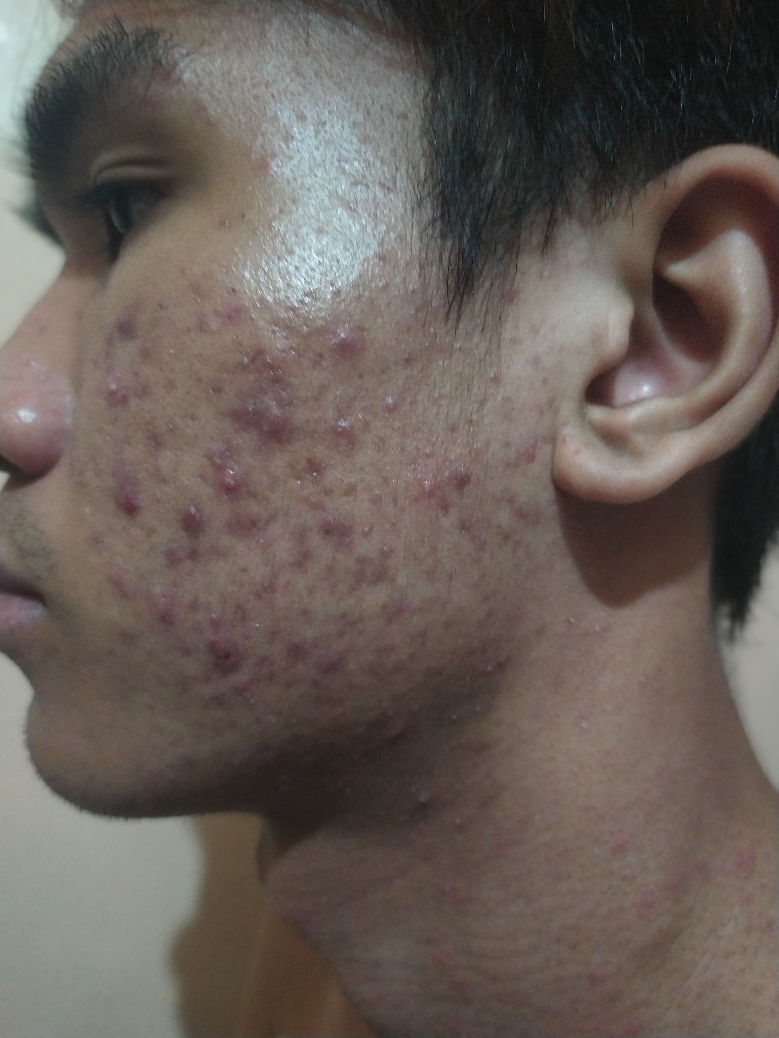 Please Help Me I Have A Severe Acne Condition General Acne