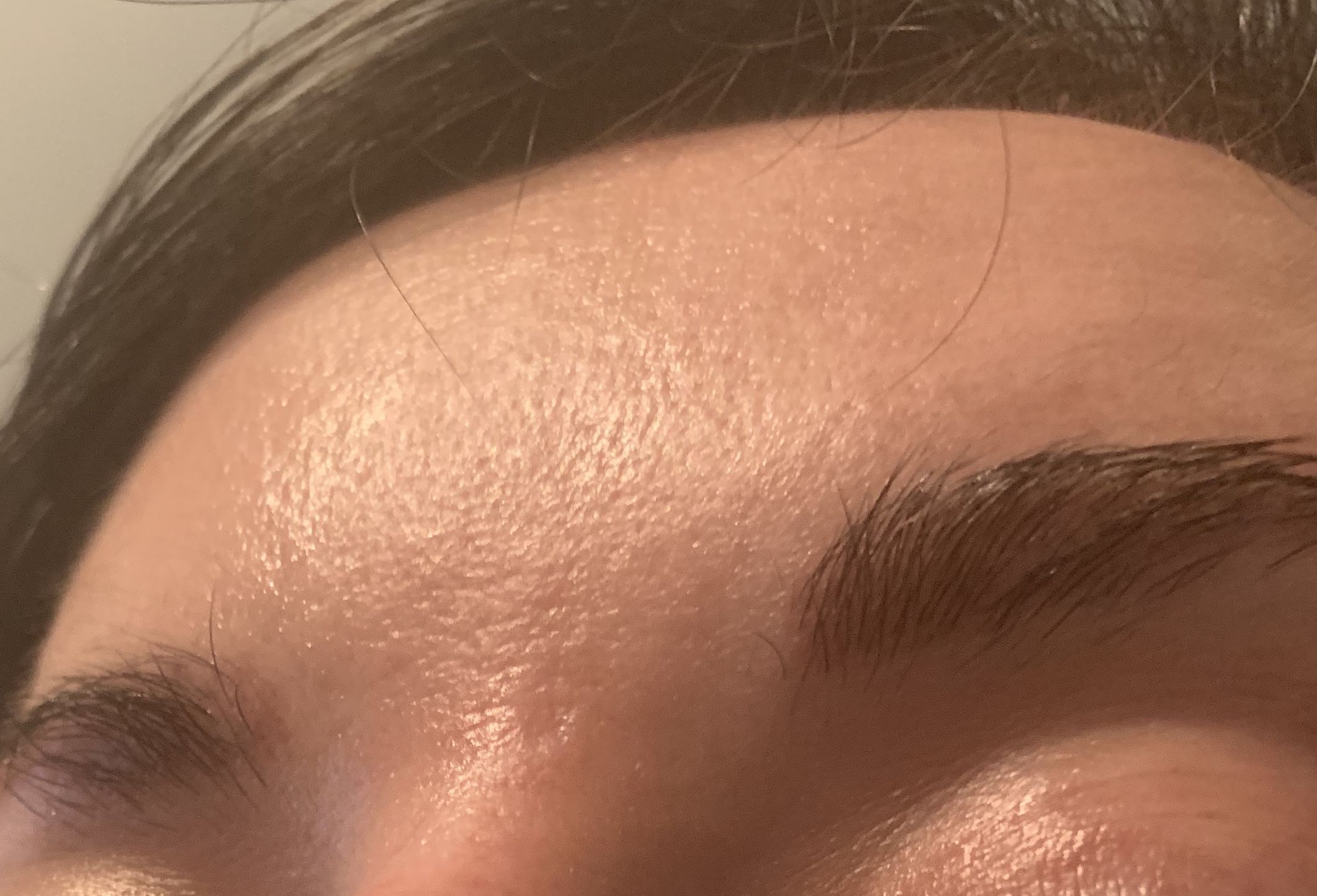Please help with acne scar that's both raised and indented