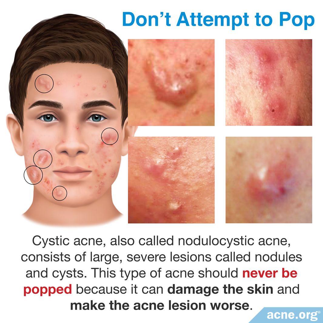 Acne Nodule Vs Cyst