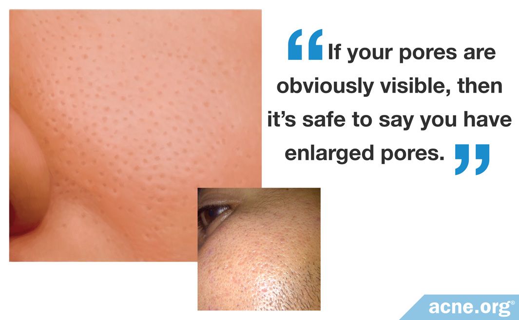 Can You Reduce The Size Of Your Skin Pores