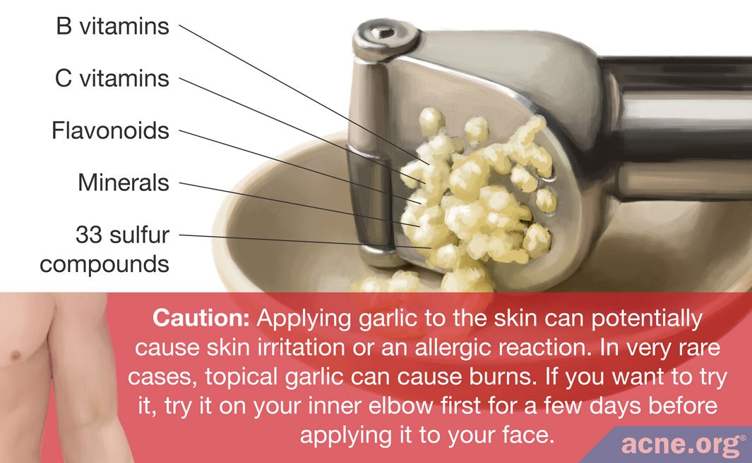 Does Garlic Help with Acne?