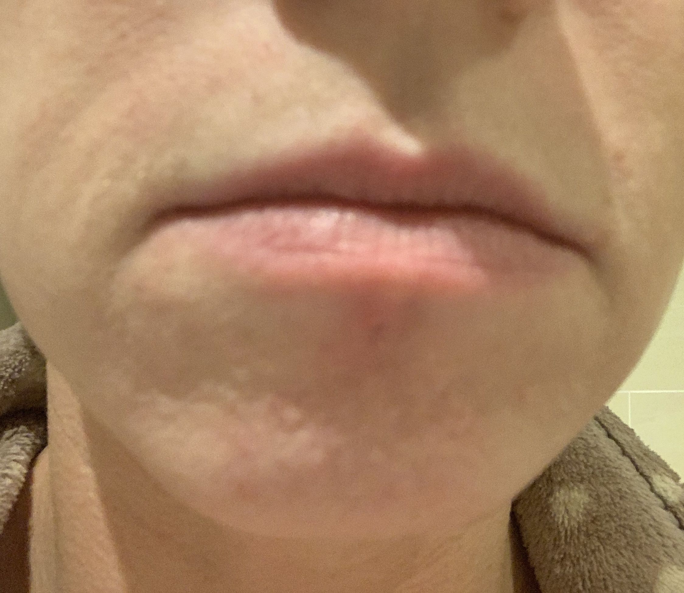 Skin Colored Bumps On Chin Treatment Hypertrophic Raised Scars Acne Org Forum