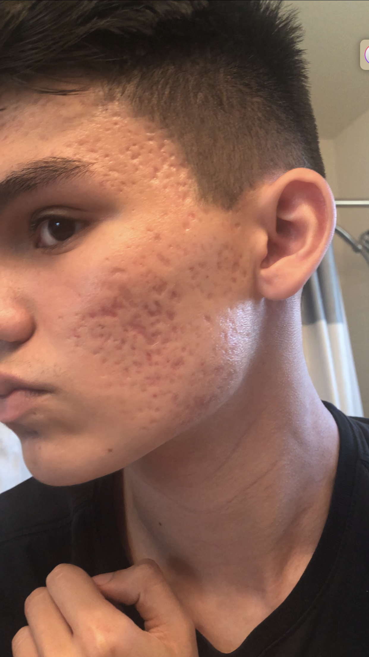 Severe Acne Scarring Scar Treatments