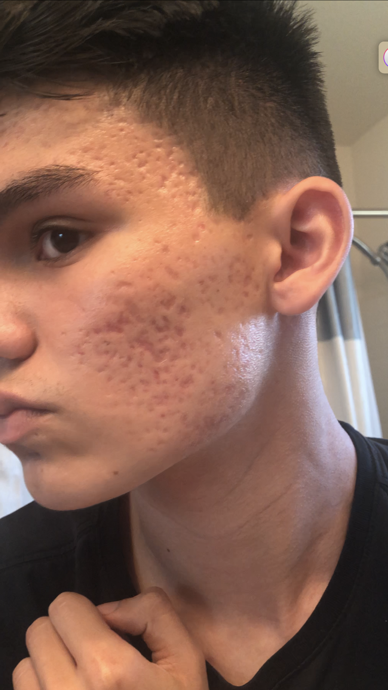 Severe Acne Scarring Scar Treatments Acne