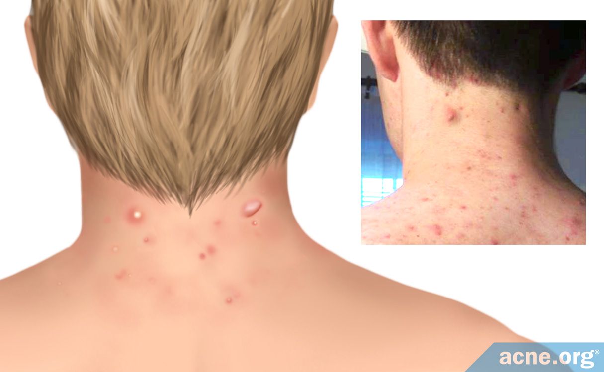 Neck Acne Treatment