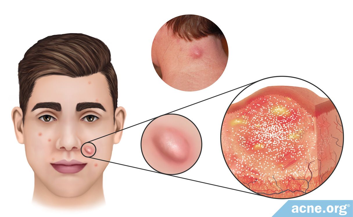 What Is An Acne Nodule Acne Org