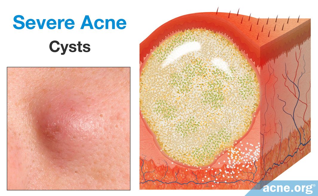 What Is Acne An In Depth Look 