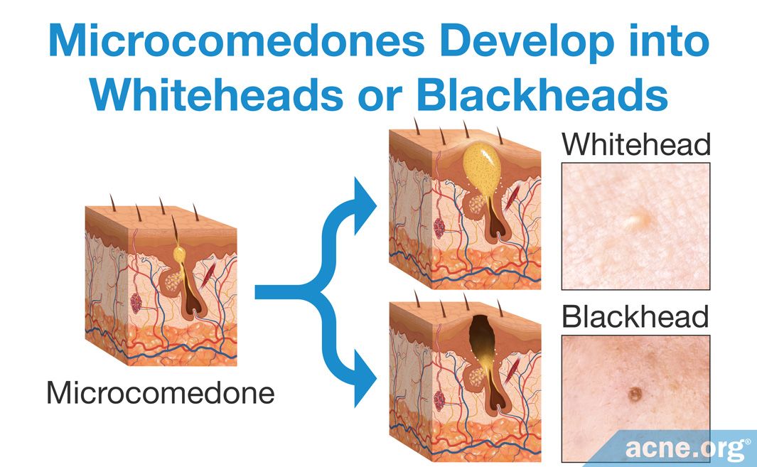 what-is-comedone-extraction-and-should-you-do-it-acne