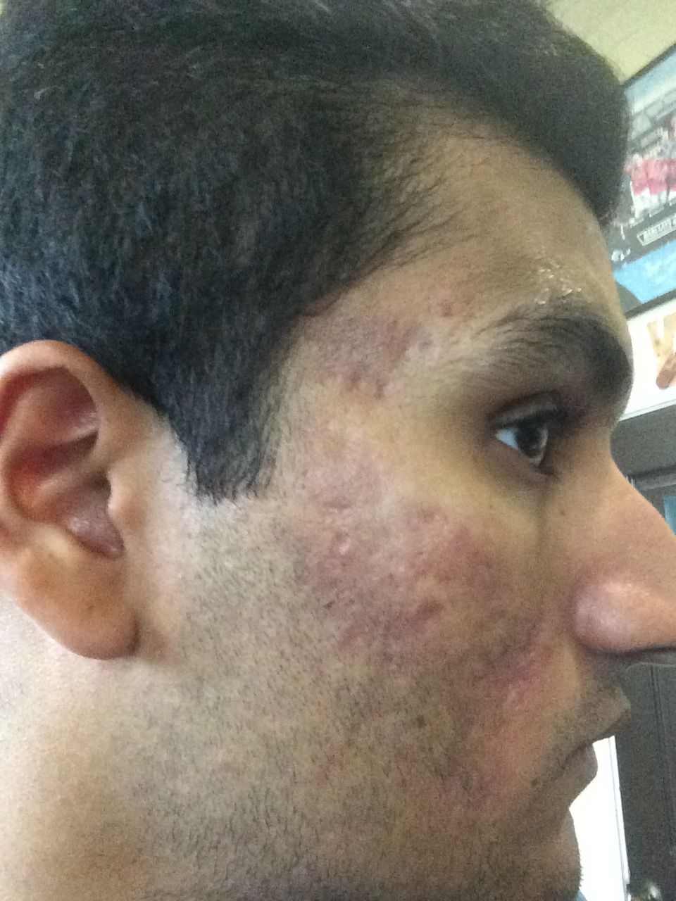 3 weeks after my first session of micro needling - Hyperpigmentation