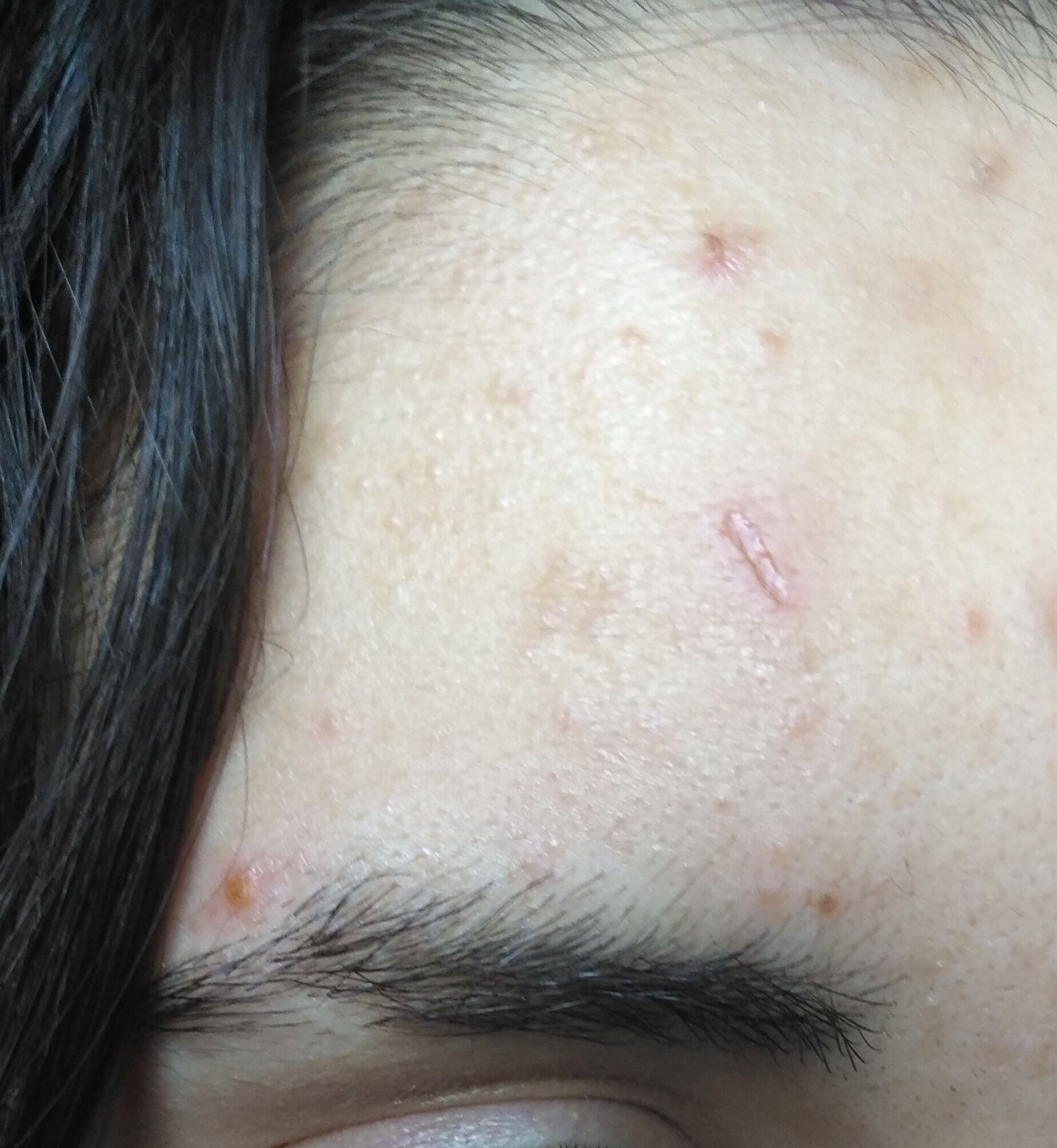 Atrophic Scar In Forehead Scar Treatments Forum